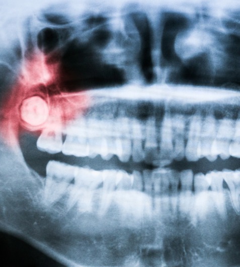 Wisdom Tooth Surgeries - Impaction